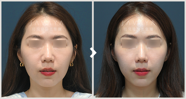 肉毒注射斜方肌｜見證案例_02